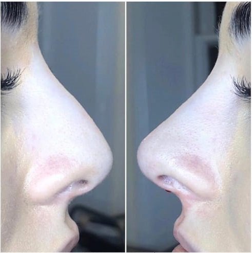 Как большой нос сделать маленьким без операции? Самый честный и подробный рассказ косметолога о модной процедуре 